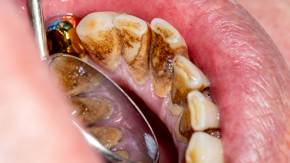 Tartar on Teeth (Dental Calculus): Causes & Removal