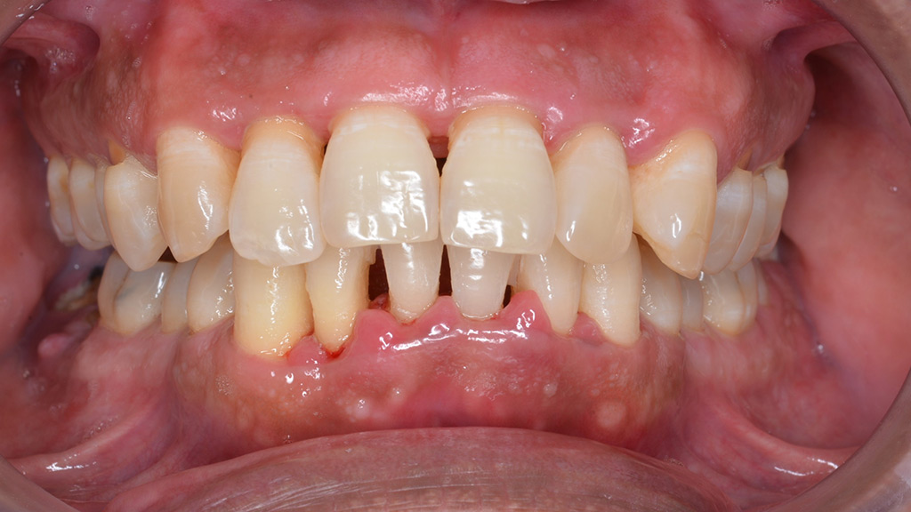 periodontitis gum disease