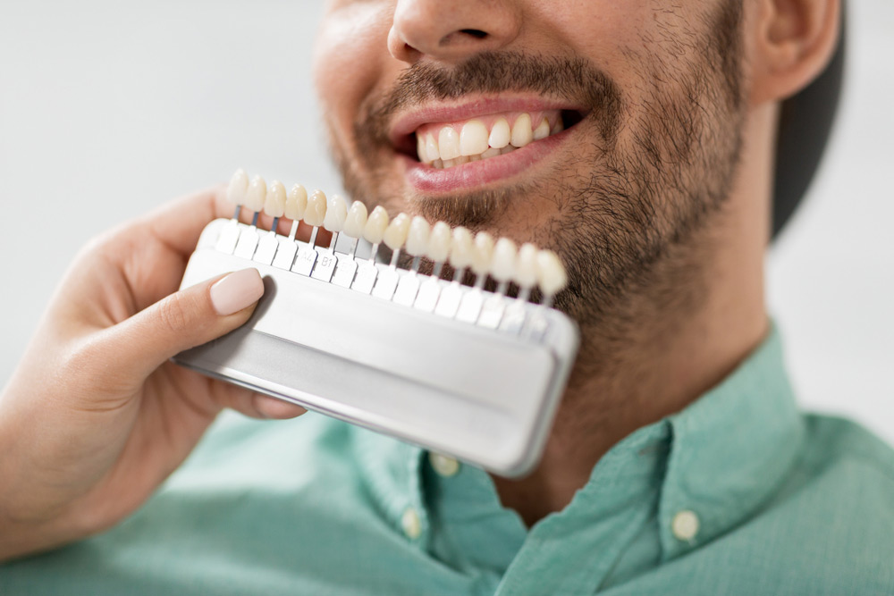 What are veneer teeth?
