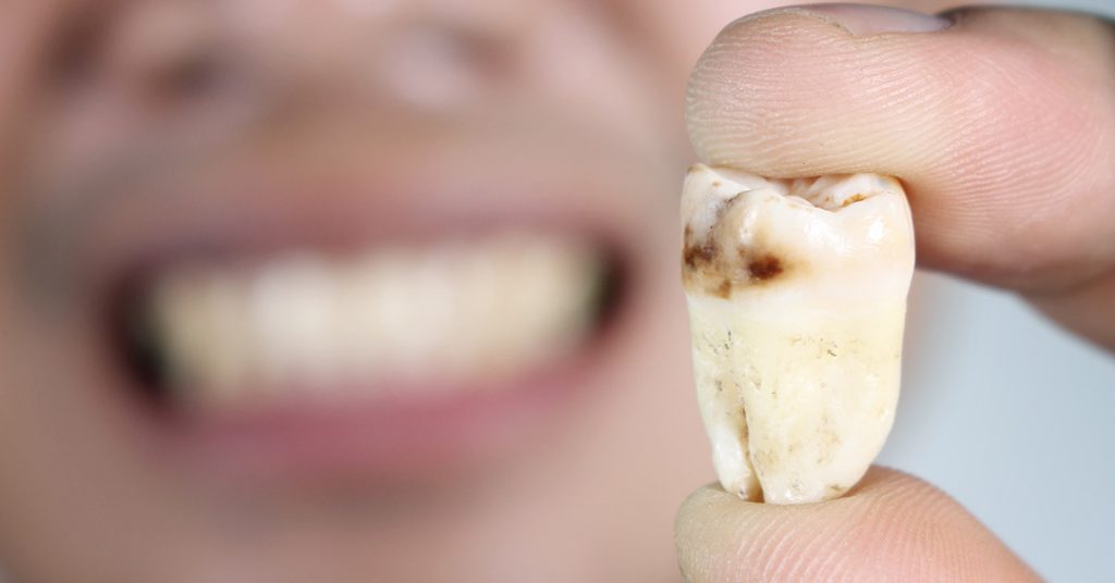 Tooth decay cavities causes and treatment