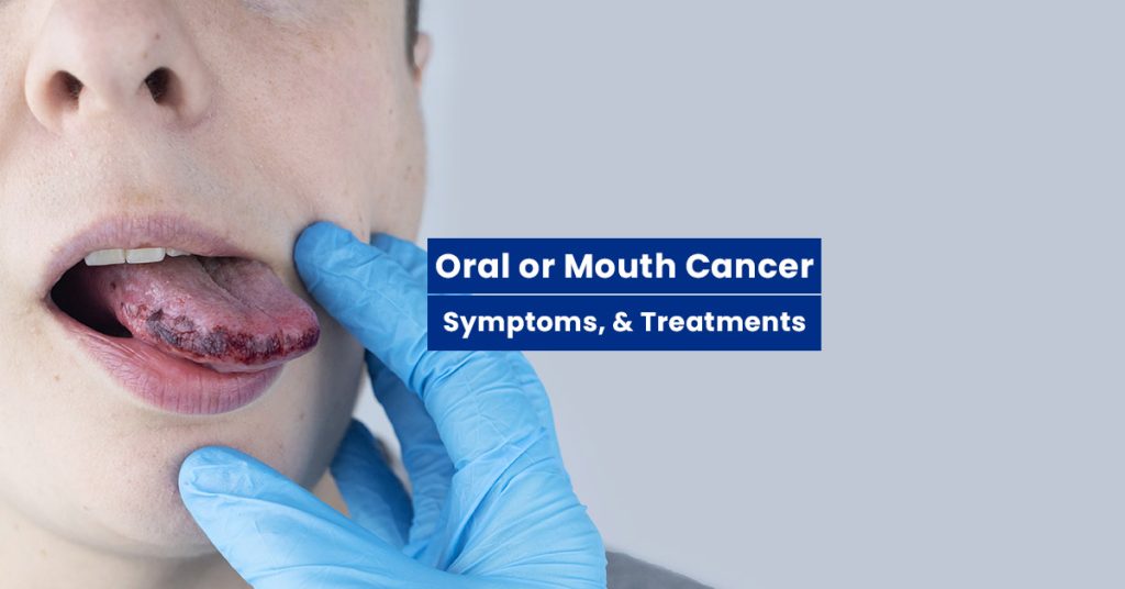 Oral, tongue Mouth Cancer Signs treatments