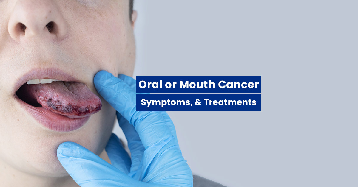 Radiation Therapy for Mouth Cancer (Oral Cancer)