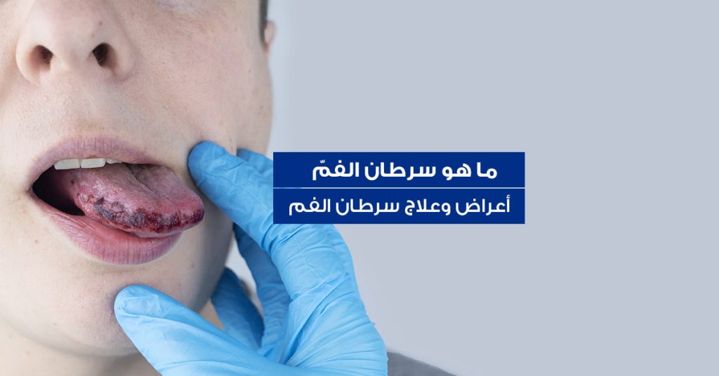 أعراض وعلاج سرطان الفم