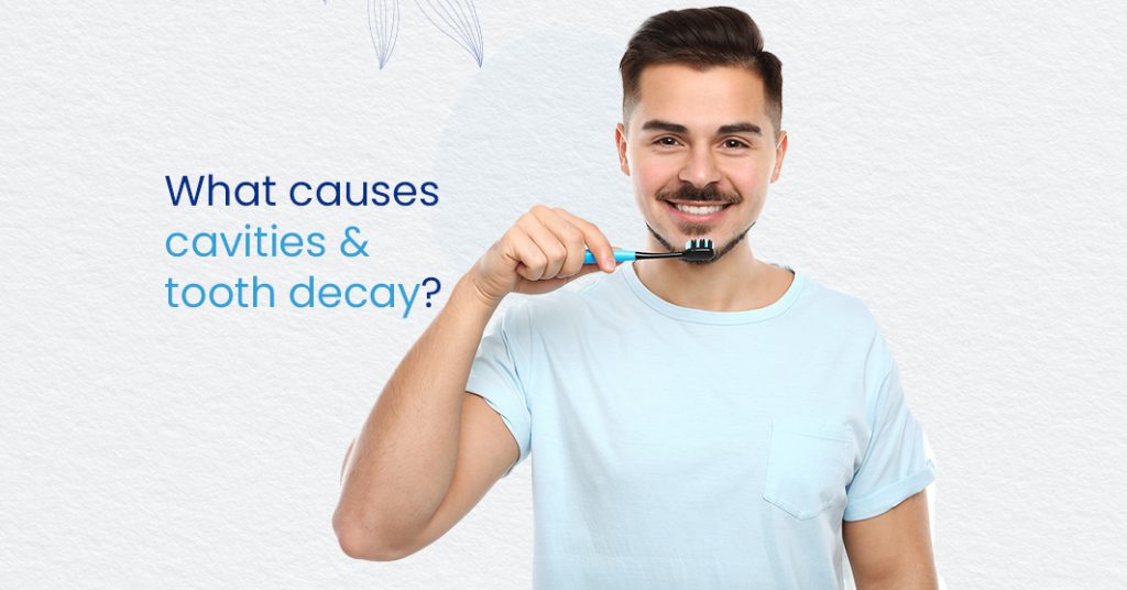 What causes cavities & tooth decay?
