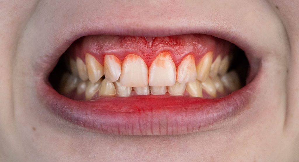 Teeth Bleeding Gums