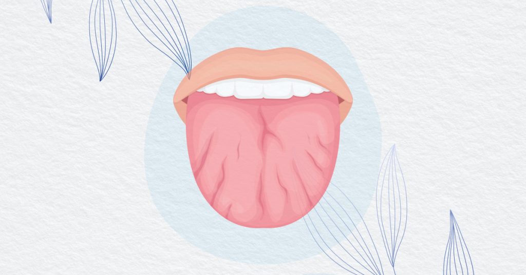 Cracked Tongue: Causes and Effective Treatment
