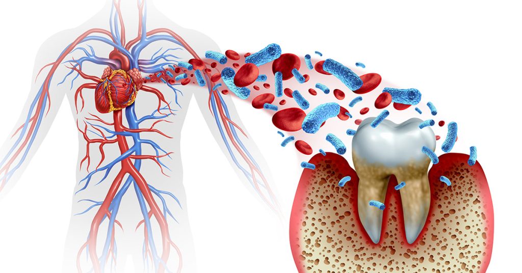 Heart Disease and Oral Care Tooth Decay