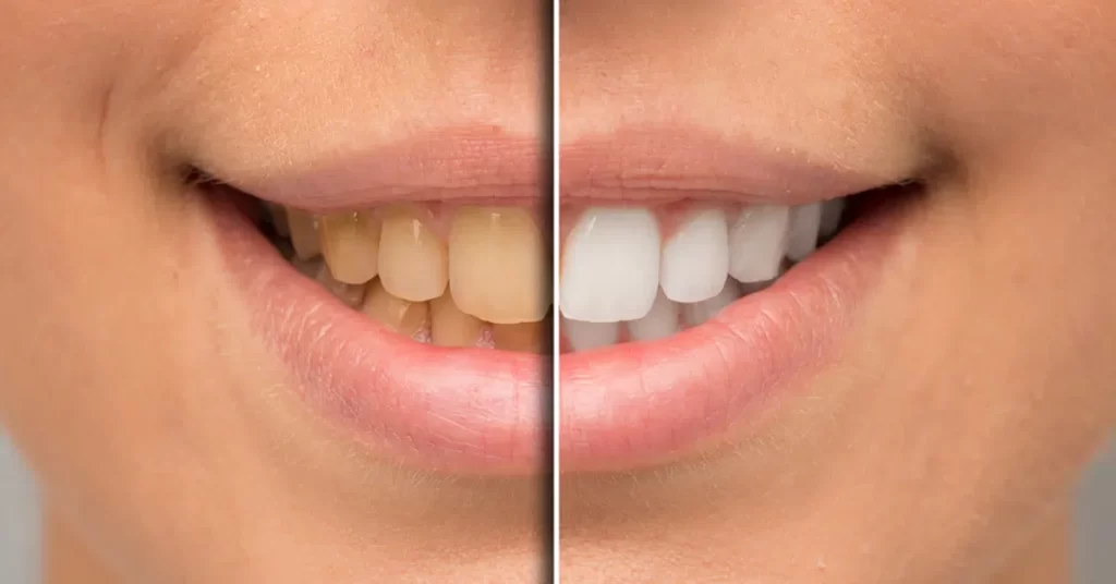 What Is Hollywood Smile?