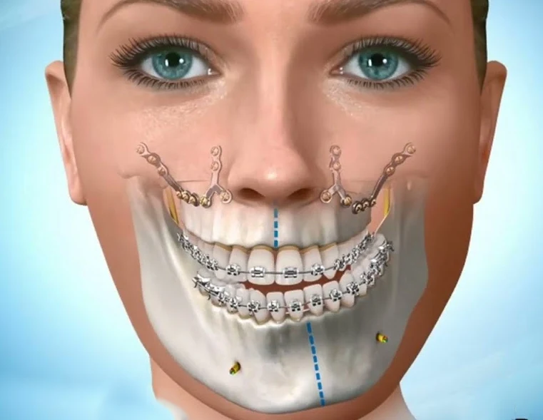 Crossbite jaw surgery