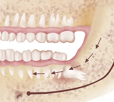 استخراج الأسنان المتجذّرة