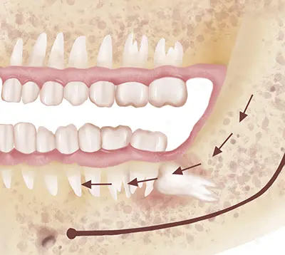 Impacted Wisdom Teeth Extraction