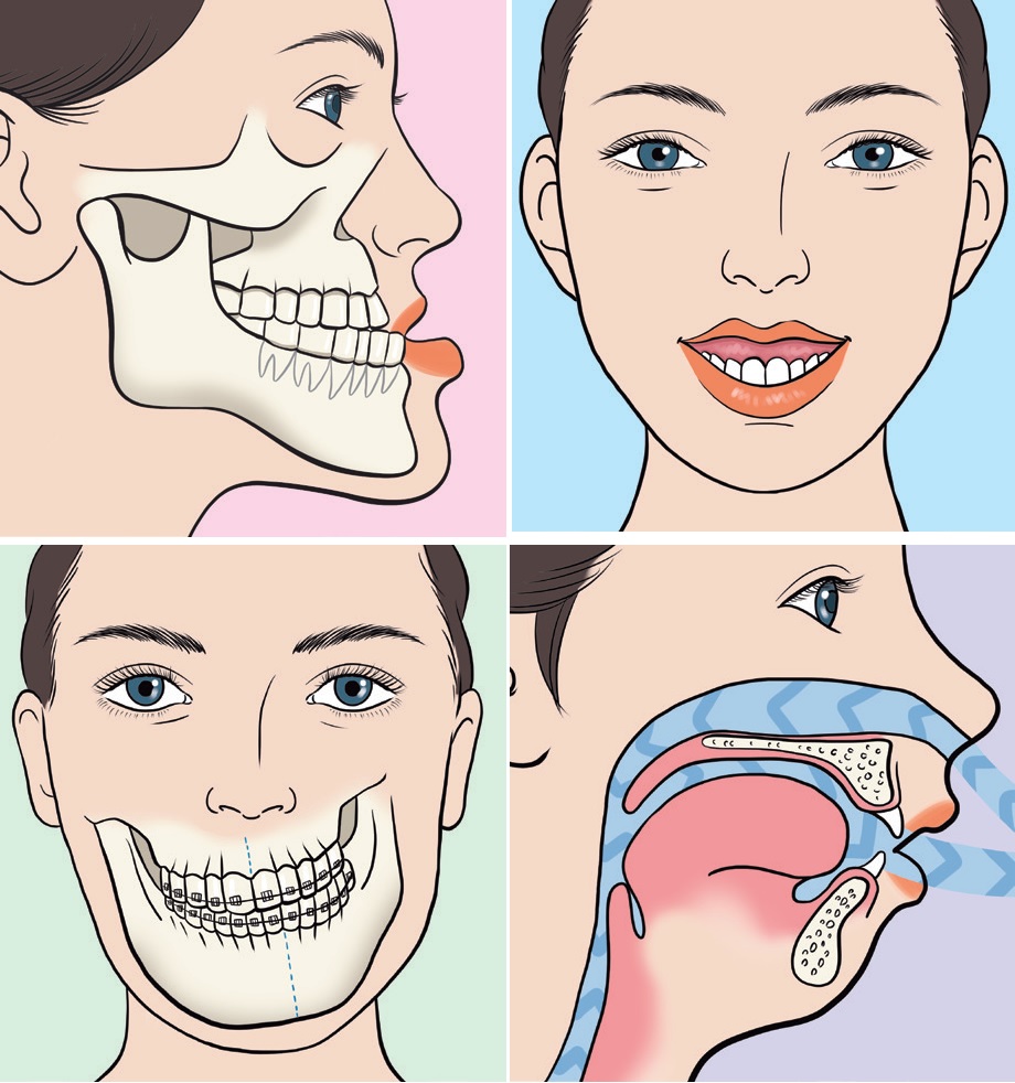 Orthognathic Surgery