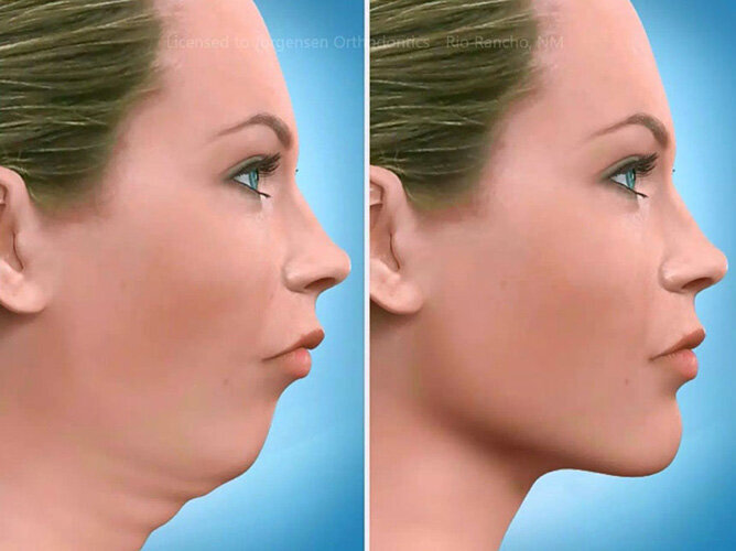 Orthognathic overbite surgery