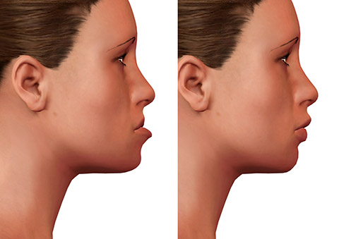 Orthognathic jaw underbites surgery 