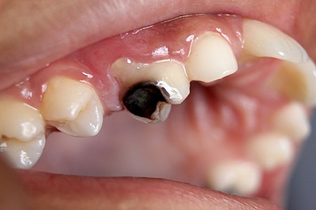 Tooth Decay Type - Coronal Decay