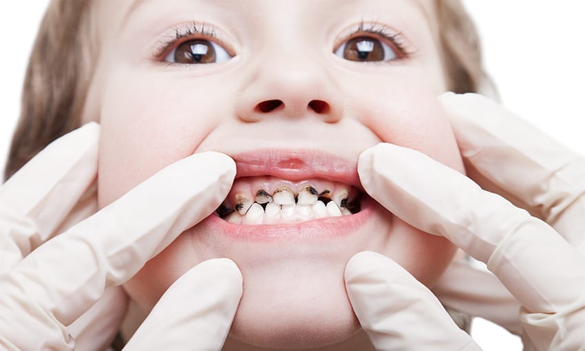 Early Childhood Tooth Carries Decay