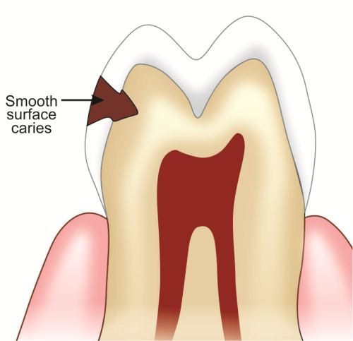 Smooth Surface Carry Tooth Decay