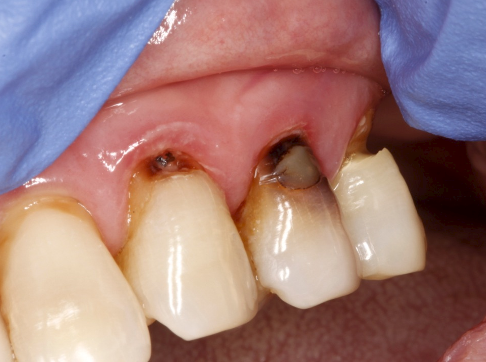 Tooth Decay Type - Root Tooth Decay