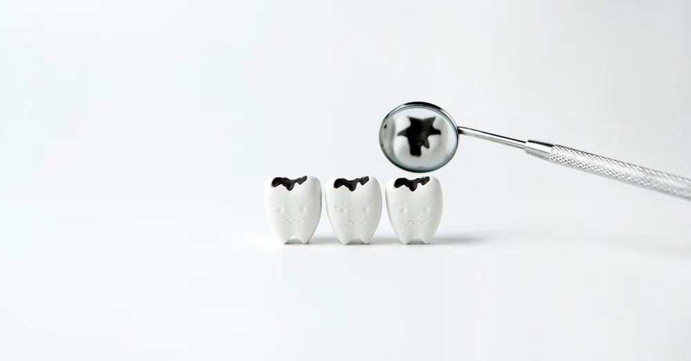 أنواع تسوّس الأسنان بالصور