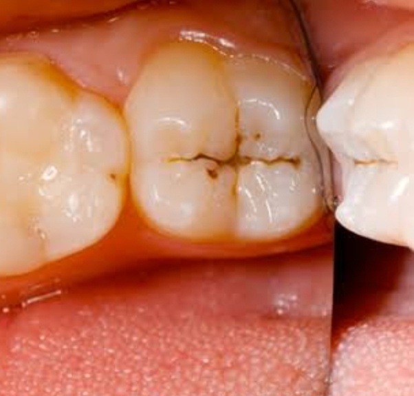 Tooth Pit Fissure Crack Decay