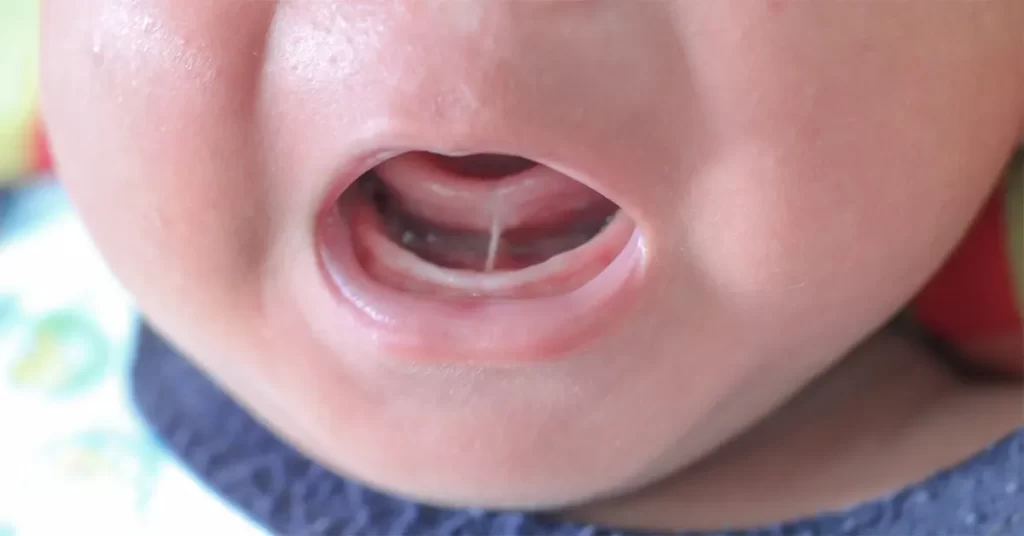 Kids Tongue Tie & Speech Delay: Cause, Intervention, Treatment