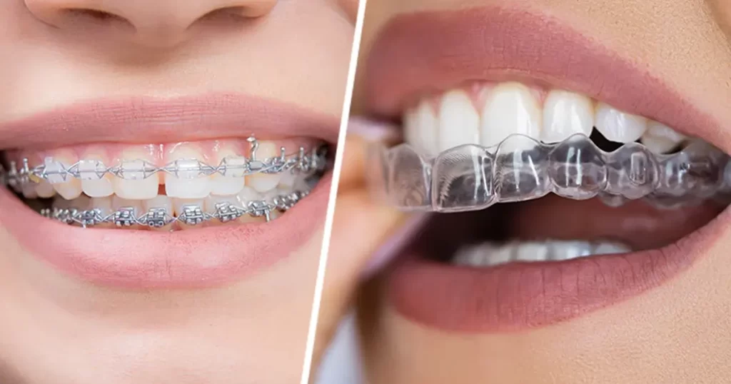Clear Braces vs. Metal Braces: Choosing the Right Orthodontic Treatment