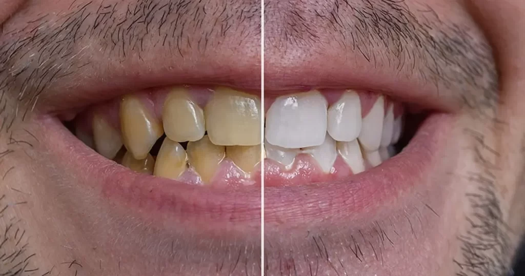 اصفرار الأسنان: أسباب وعلاج الأسنان الصفراء