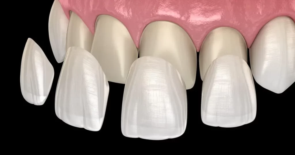 العوامل الأساسية قبل الحصول على فينير الأسنان